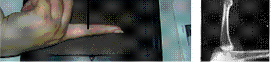 Proyección lateral dedo